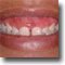 Laser Gum Shaping Before/After Case Study & Images