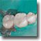 Replaced Metal Fillings Before/After Case Study & Images