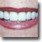 Close-up Of Veneers Before/After Case Study & Images
