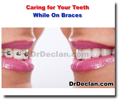https://www.drdeclan.com/newsimages/caring-for-your-teeth-while-on-braces-honolulu-dentist-ala-moana-dental-care-hawaii-254432.jpg