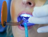 The Facts About Tooth Whitening
