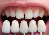 Veneers