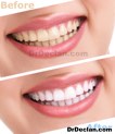 Dental Case Studies and Before and After Photos - Honolulu Dentist - Ala Moana Dental Care Hawaii